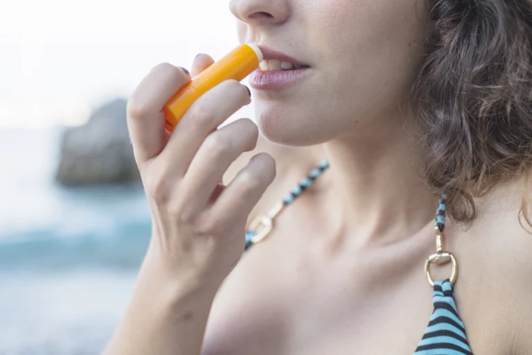 sunburn lips remedy